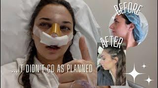 I got a nose job *in secret* and vlogged the process