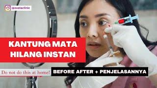 Filler Kantung Mata Before and After (Suntik Sendiri ???) - Ovela Clinic Jakarta