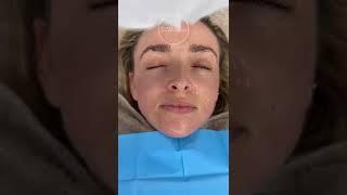 Microneedling treatment