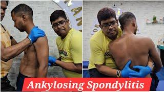 Chiropractic treatment for Ankylosing Spondylitis.