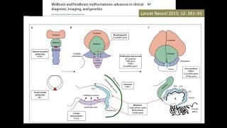 Hind brain embryology through pathology