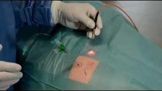 Laser therapy of an advanced coxarthrosis with the Weberneedle® Endo Laser