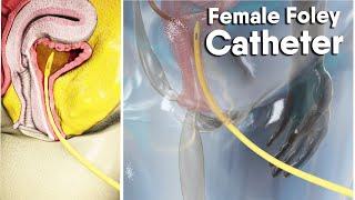 Female Foley Catheter | dandelion medical animation