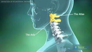 Atlantoaxial instability. Definition