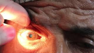 iris shadow in cataract