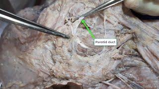 Parotid gland I - External features