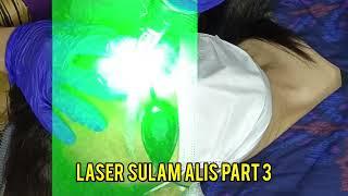 LASER SULAM ALIS PART 3