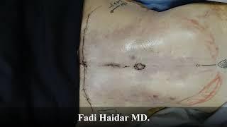 Lipoescultura, Abdominoplastia, Lipectomía de Alta Definición (Liposucción HD) - Cuerpo Esculpido 