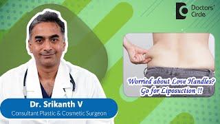 Liposuction Of Flanks (Love Handles)| Lower Back Liposuction #lipo  -Dr. Srikanth V |Doctors' Circle