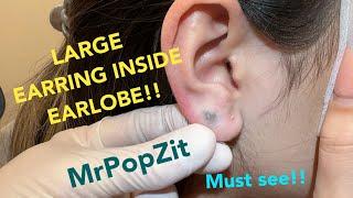 Giant earring completely hidden inside earlobe.Foreign body pop,Metal extraction.Must see to believe