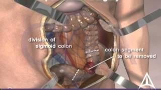 Colorectal cancer surgery - Open procedure - 3D animation