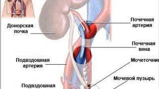 Трансплантация почки.