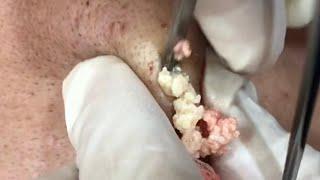 臉部粉瘤切除 美麗新城診所莊禮謙醫師 epidermal cyst, Dr George