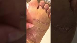 TikTok Compilation - August 2023 - Foot Callus Pedicures EPPK Shaving Scraping Feet Care Satisfying
