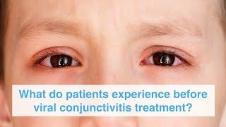 What do patients experience before viral conjunctivitis treatment?