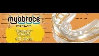 Myobrace for braces