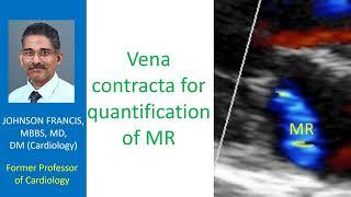 Vena contracta for quantification of mitral regurgitation