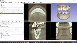 Tutorial: How To Create STL segmentation from DICOM using 3D Slicer (Virteasy Dental / Editor)