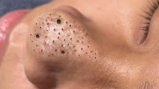 Big Cystic Acne Blackheads Extraction Blackheads & Milia, Whiteheads Removal Pimple Popping # 554