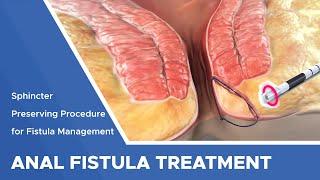 Closure of Fistula Tract with Laser