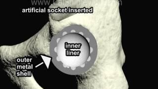 Hip Replacement Surgery - Animation by Cal Shipley, M.D.