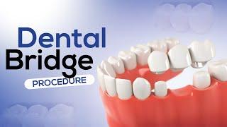 Dental Bridge Procedure 3D Animation