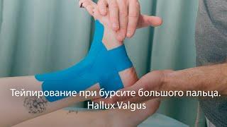 Тейпирование при бурсите большого пальца. Hallux Valgus