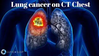 Left Lower Lobe lung cancer with abnormal mediastinal lymph nodes for staging and a RUL nodule