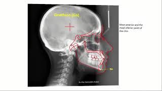 cephalometric landmarks