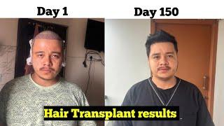 Day 1 to Day 150 Hair Transplant result / Hair Transplant in Nepal / Rabin thapa