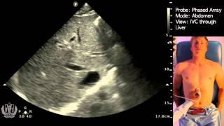 IVC Ultrasound STEP by STEP - Easiest Method