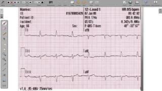 ECG 12 Lead Axis Deviation