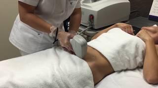 Best LASER hair removal for MEN Women in Mississauga with Light Sheer or Soprano Ice Laser