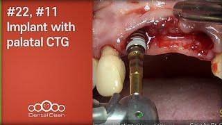 #22, #11 Implant with palatal CTG - [Dr. Cho Yongseok]