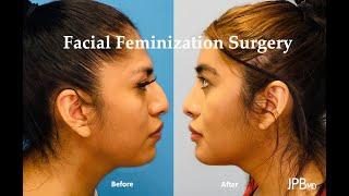 Facial Feminization Surgery