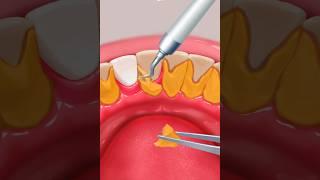 ASMR remove teeth tartar & food stuck clean teeth 2d animation video Habib khan ASMR treatment