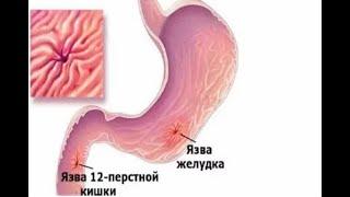 Язвенная болезнь желудка и 12-перстной кишки. Причины, симптомы, стадии и сроки рубцевания язвы