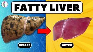 Strictly Avoid these 5 Foods if you have Fatty Liver | Fatty liver treatment | liver disease