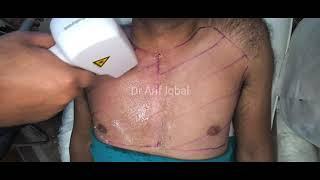 Men's chest laser hair removal with diode laser by Dr.Arif Iqbal