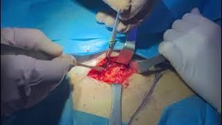 Autologous costal cartilage harvesting#secondaryrhinoplasty#revisionrhinoplasty