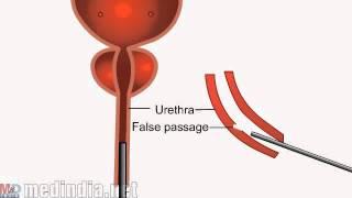 Urethral False Passage