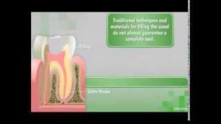 GuttaFlow2 D- Root Canal Filling System