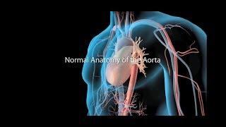 Aortic Aneurysm and Aortic Dissection