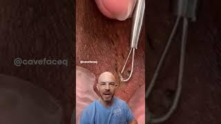 Armpit cyst and ingrown hair removal  #dermreacts #doctorreacts #ingrownhair #satisfying #cystpop