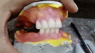 Dental Art by Haider || Complete Denture Set-up By Haider..