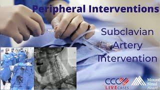 Subclavian Artery Intervention