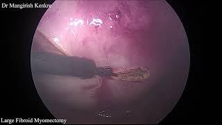 Laparoscopic Myomectomy - Incision for a Large Fibroid