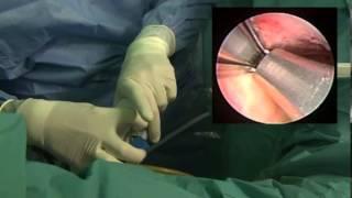 Minimally Invasive Prostatic Urethral Lift: Surgical Technique and Multinational Experience