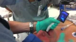 McGRATH MAC Video Laryngoscope - intubation #1