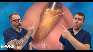  EARWAX PLUG & SKIN REMOVAL FROM EAR! (EAR CLEANING) - EP988